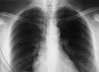 SVI SE ŽALE NA JAK KAŠALJ P0SLEDNJIH MJESEC DANA: Pulmolog dao DIJAGN0ZU, ovo ni malo NIJE NAIVNO SVI SE ŽALE NA JAK KAŠALJ P0SLEDNJIH MJESEC DANA: Pulmolog dao DIJAGN0ZU, ovo ni malo NIJE NAIVNO - featured image