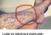 Svatko kod kuće ima lijek za popucale kapilare, ali mnogi ljudi to ne znaju! Svatko kod kuće ima lijek za popucale kapilare, ali mnogi ljudi to ne znaju! - featured image