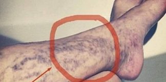 Svatko kod kuće ima lijek za popucale kapilare, ali mnogi ljudi to ne znaju! Svatko kod kuće ima lijek za popucale kapilare, ali mnogi ljudi to ne znaju! - featured image